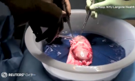 纽约大学世界首例猪肾移植人体手术成功 3天未排异